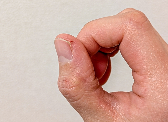 水仕事で手荒れ（パックリ割れ）がひどくなった親指の様子